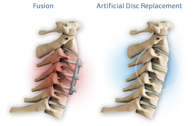 Comparison between a cervical fusion and a artificial disc
