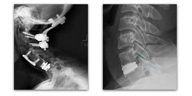 Comparison of procedure invasiveness between a cervical fusion and a artificial disc