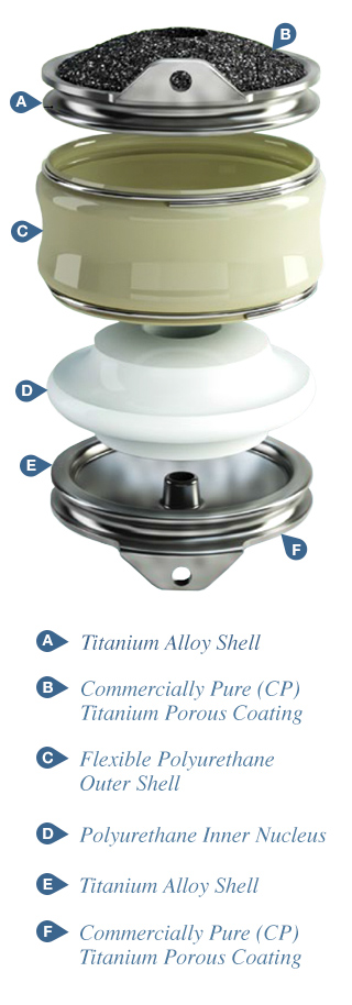 Artificial Disc Replacement Assembly