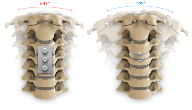 Range of motion comparison between a cervical fusion and a artificial disc