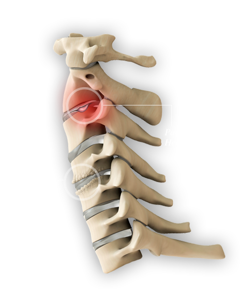 A spine with traditional cervical fusion