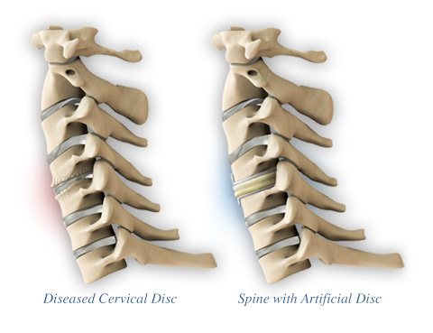 Diseased Disc and Artificial Disc Replacement