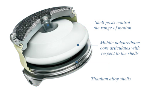 Artificial Disc Replacement Assembly